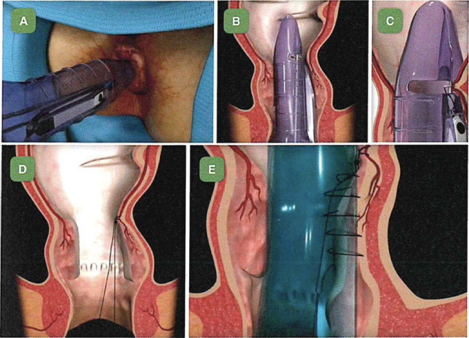 Tecnica THD per emorroidi in day surgery