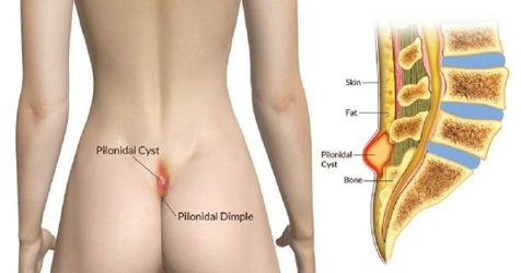 Tecnica endoscopica EPSIT per cisti pilonidale