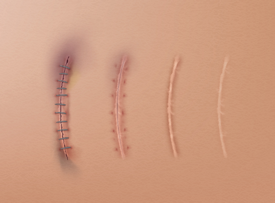 Piccola cicatrice quasi invisibile