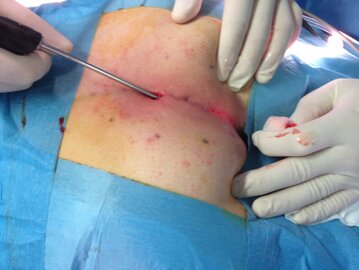 Strumenti endoscopici per procedura mini-invasiva EPSIT