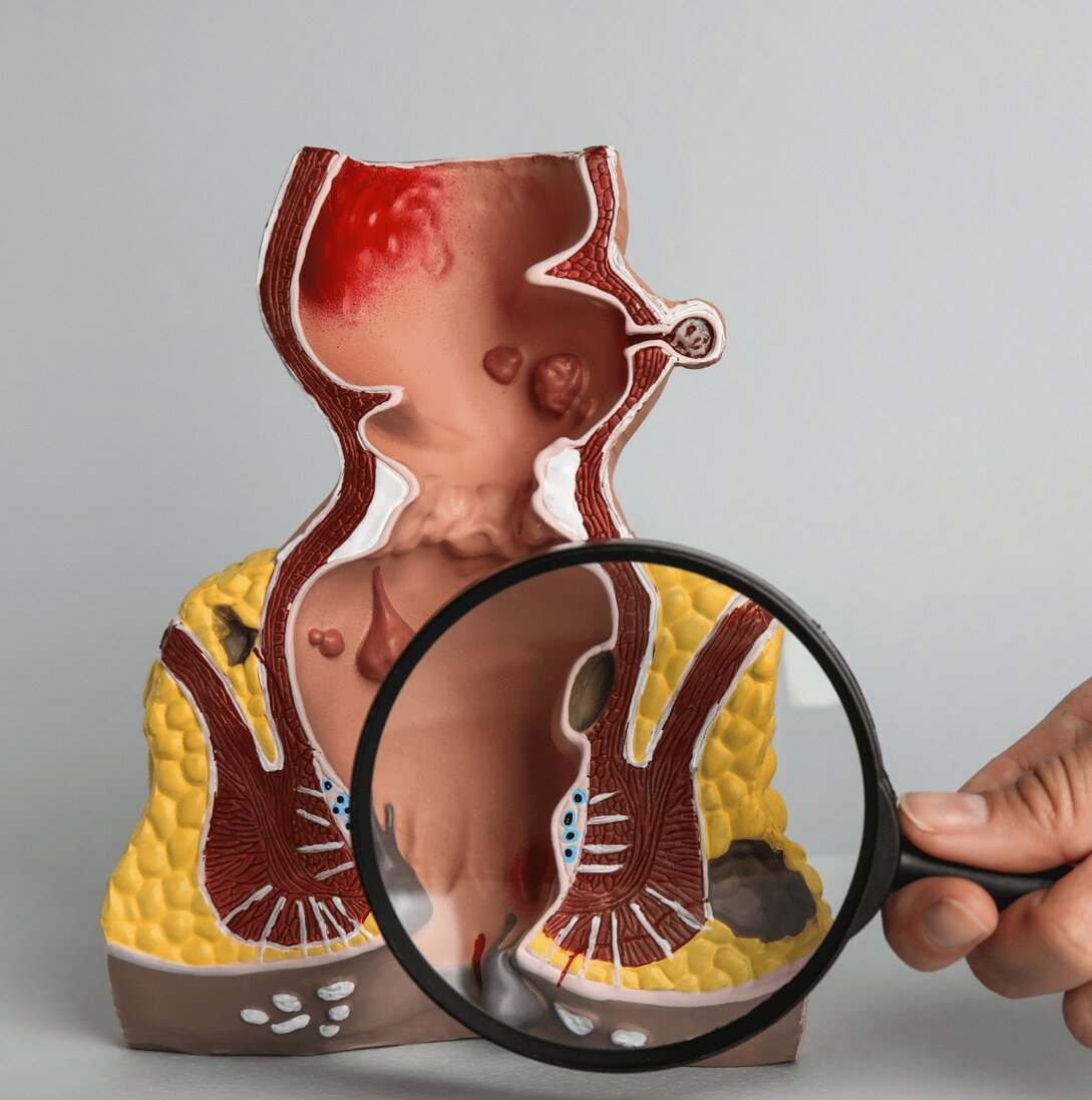 Procedura THD per emorroidi in day surgery